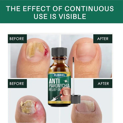 Anti Paronychia Relief Oil- Buy 1 get 1