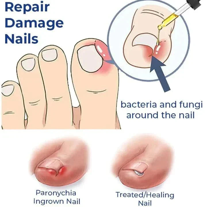 Anti Paronychia Relief Oil- Buy 1 get 1